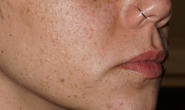 Cheek of a patient with solar lentigines: before the session