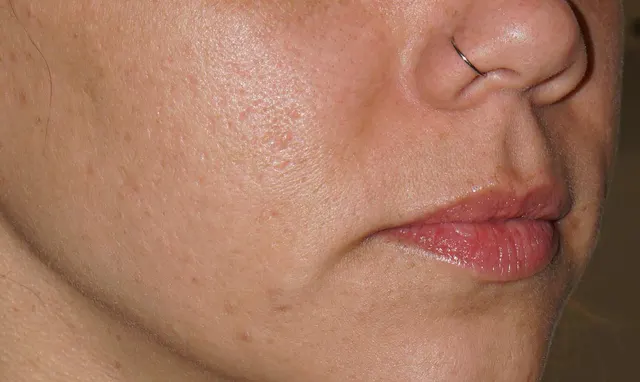 Cheek of a patient with solar lentigines: after the session
