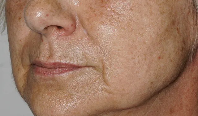 Cheek and cheekbone of a patient with solar lentigines: before the session