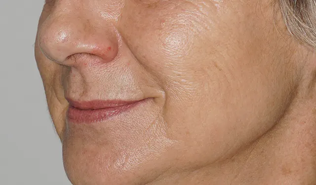Cheek and cheekbone of a patient with solar lentigines: after the session