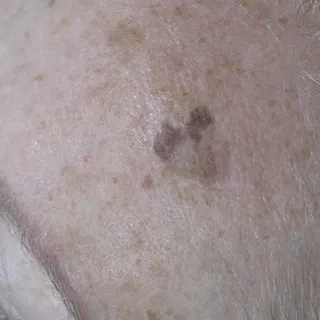 Asymmetric, two-toned pigmented lesion surrounded by solar lentigines