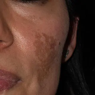 Cheek with a diffuse, poorly defined patch of melasma