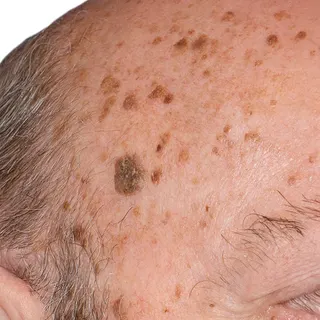 Temple with several seborrhoeic keratoses, some flat and some with a rough surface